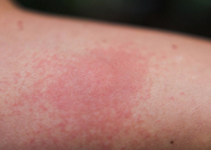 Redness from an infected mosquito bite expands around the bite. If the area develops red streaks, it may be a sign of a serious infection called cellulitis.