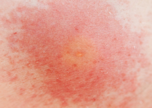 Redness on skin from wasp sting allergy.