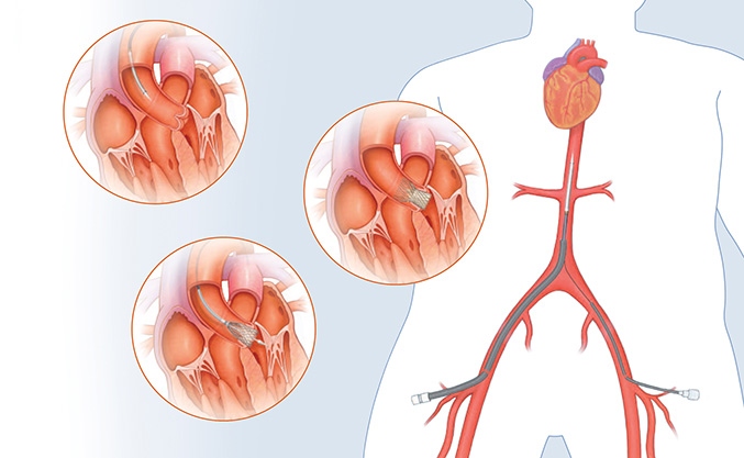 Loyola First in Illinois to Implant Newly Designed, Minimally Invasive Heart Valve