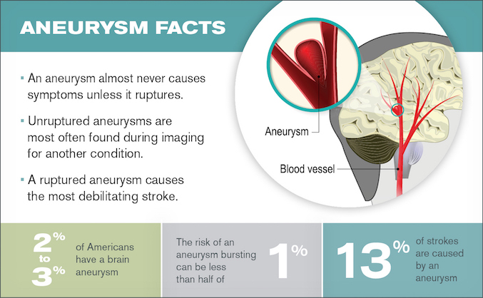 Aneurysm facts