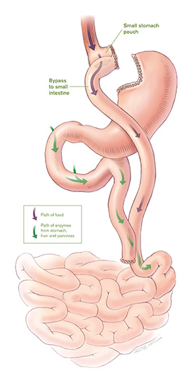 Illustration of gastric bypass surgery