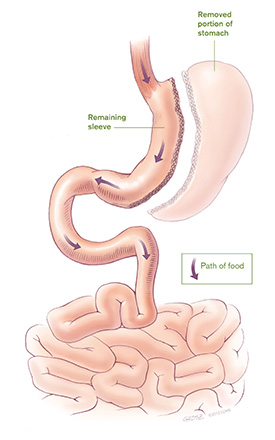 Gastric sleeve surgery