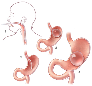 Intragastric balloon