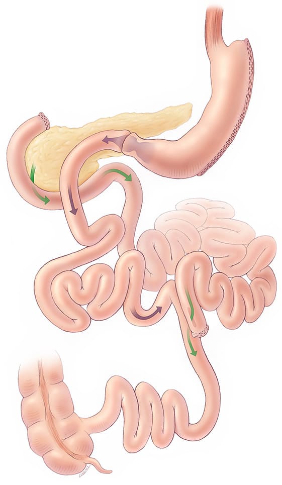 Duodenal switch surgery