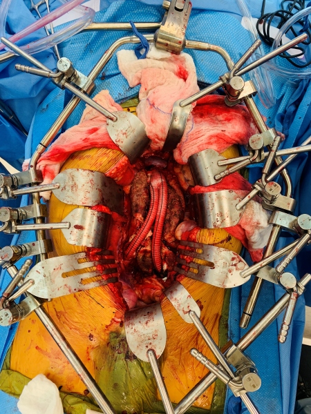 Open Juxtarenal Abdominal Aortic Aneurysm Repair