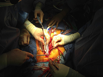 Ascending aortic replacement