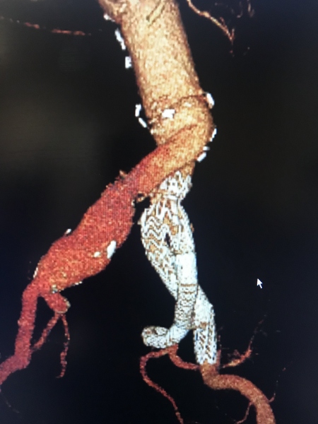 Vascular Clinical Image