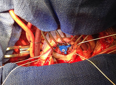 MItral valve replacement