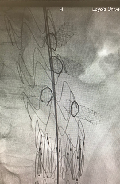  Graff Stent Xray